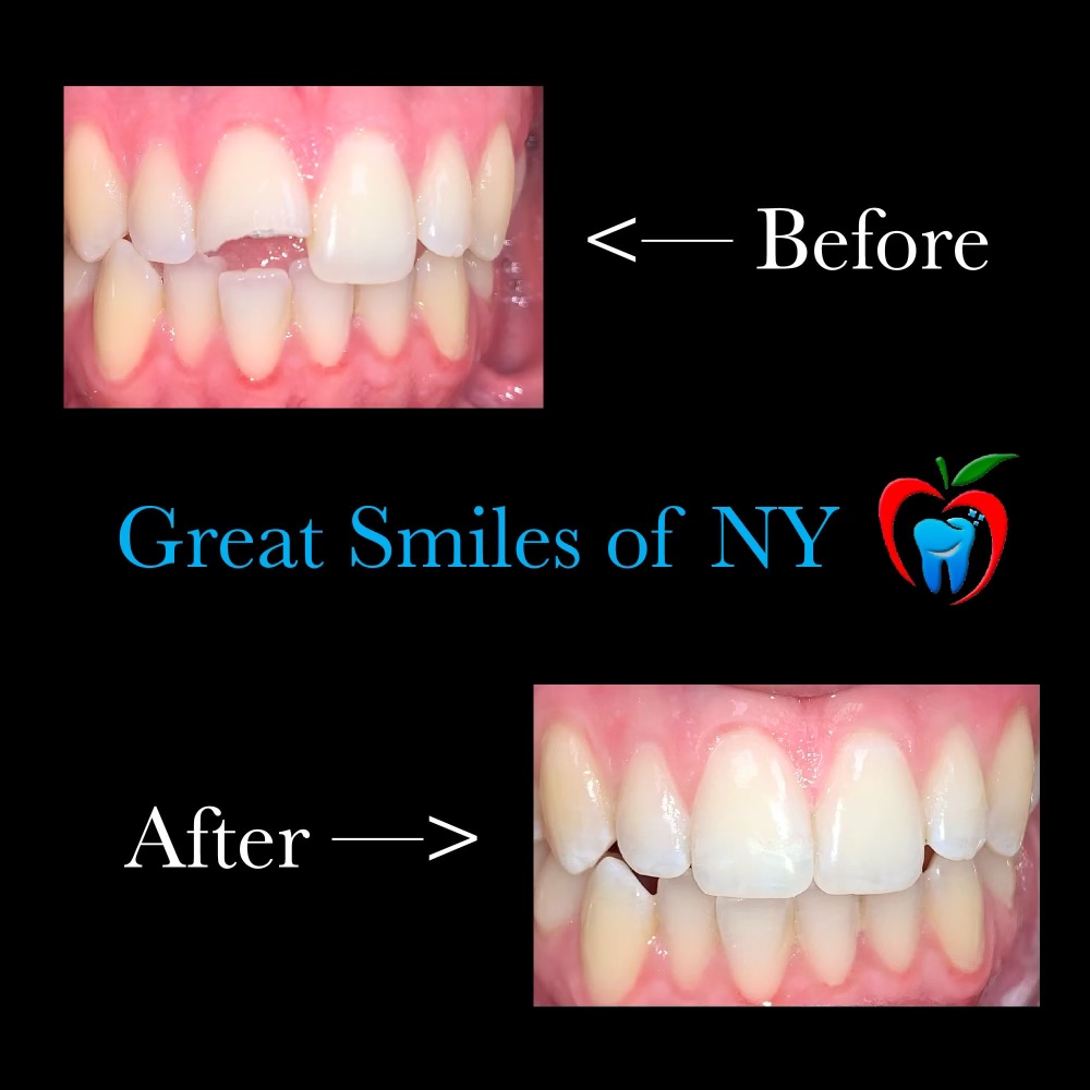 Great Smiles of NY | 97-25 64th Ave # G-3, Rego Park, NY 11374 | Phone: (718) 275-7300
