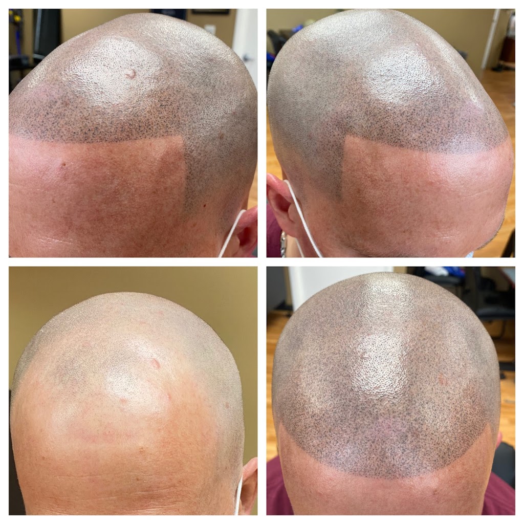 Redemption Scalp Micro Pigmentation | 657 Forrest Ave, Trooper, PA 19403 | Phone: (484) 682-2014