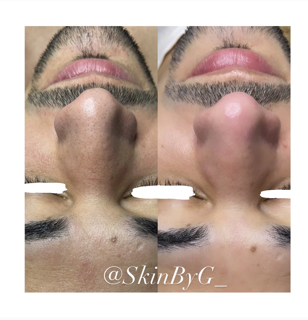 Skin By G | 104-25 Roosevelt Ave, Queens, NY 11368 | Phone: (917) 725-5757