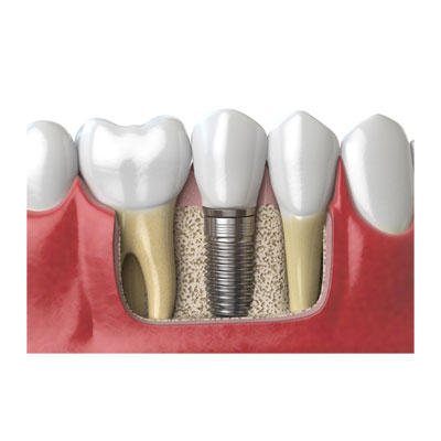 Advanced Prosthodontics | 3005 Brodhead Rd Suite 180, Bethlehem, PA 18020 | Phone: (610) 865-4222