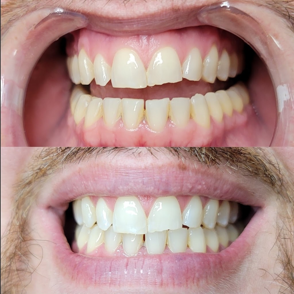 Brightens Teeth Whitening | 209 67th St, Brooklyn, NY 11220 | Phone: (347) 217-0007