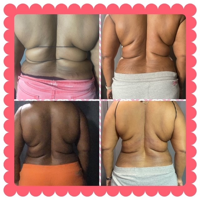 Love Your Body By Luz Body Sculpting | 46 Server St, Manchester, CT 06040 | Phone: (203) 820-4594