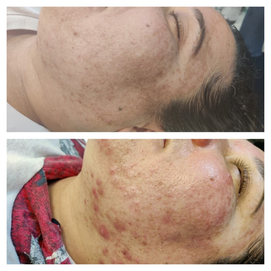 Clearly Beautiful Skin and Acne Clinic | 6212 Main St, Center Valley, PA 18034 | Phone: (484) 519-0016