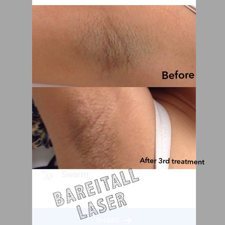 Bare It All Laser | 2472 Sycamore Ave, Wantagh, NY 11793 | Phone: (929) 251-2789