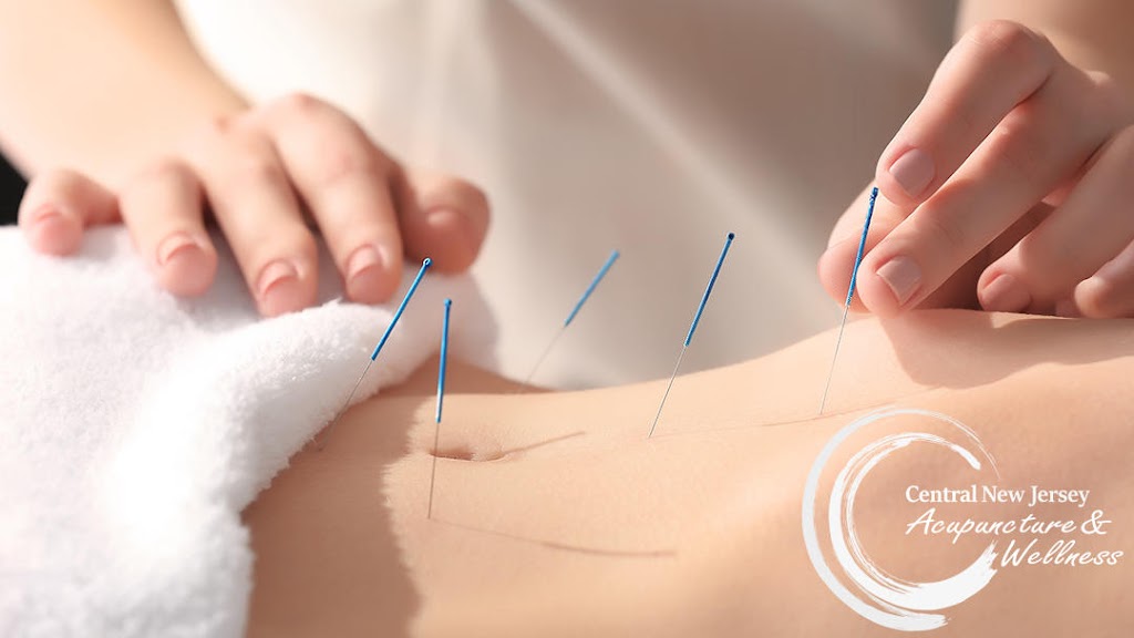 Central New Jersey Acupuncture & Wellness | 1 Bethany Rd STE 83, Hazlet, NJ 07730 | Phone: (732) 285-4184
