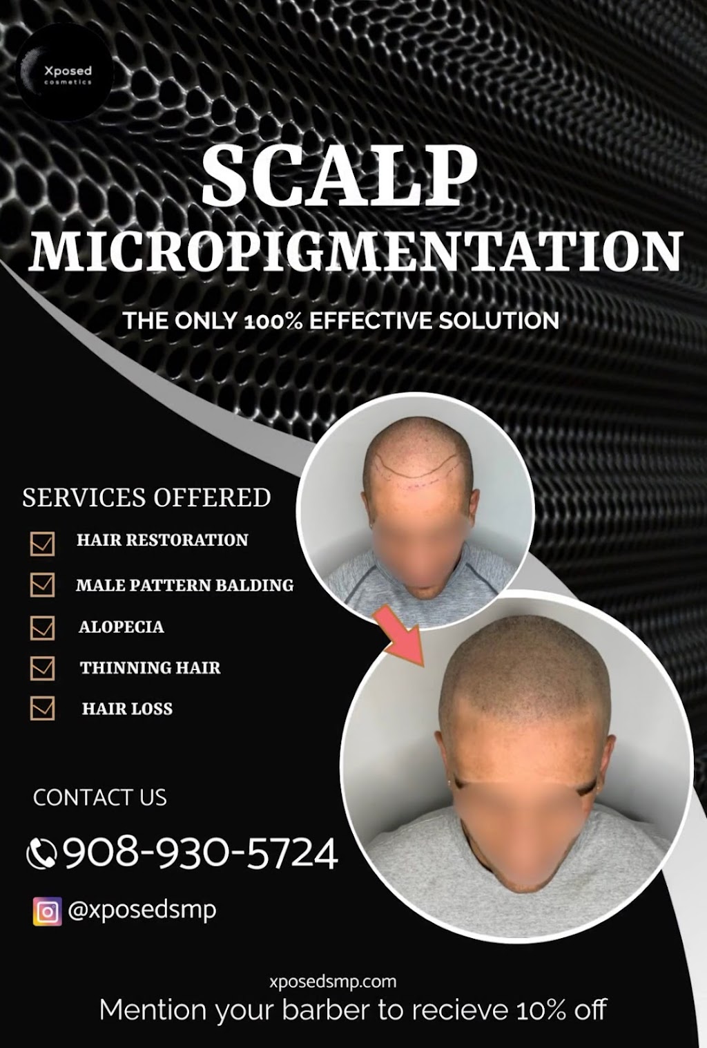 Xposed Scalp Micropigmentation | 16 Dancaster Ct, Sayreville, NJ 08872 | Phone: (908) 930-5724