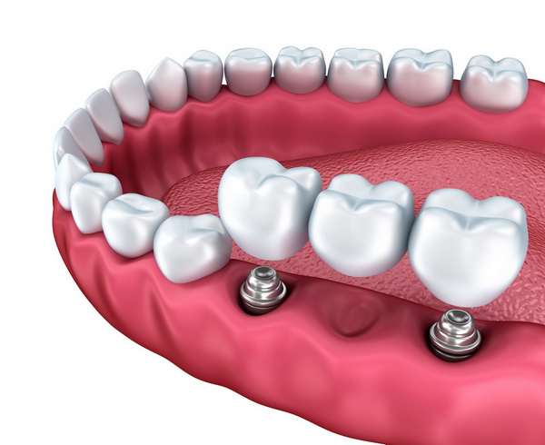 Implant Denture Sussex County | 516 Co Rd 515, Vernon Township, NJ 07462 | Phone: (973) 787-5746