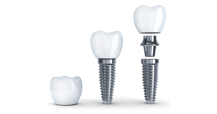 Implant Denture Somerset County | 61 Laurel Ave, Kingston, NJ 08528 | Phone: (973) 787-5745