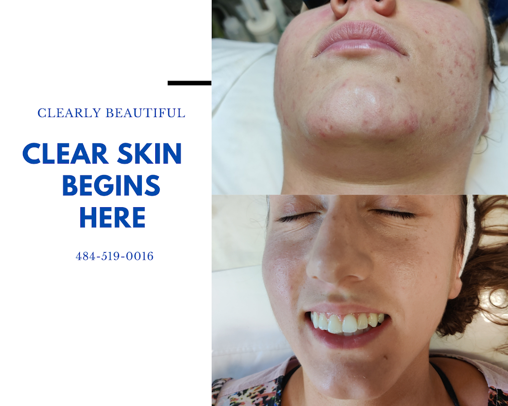 Clearly Beautiful Skin and Acne Clinic | 6212 Main St, Center Valley, PA 18034 | Phone: (484) 519-0016