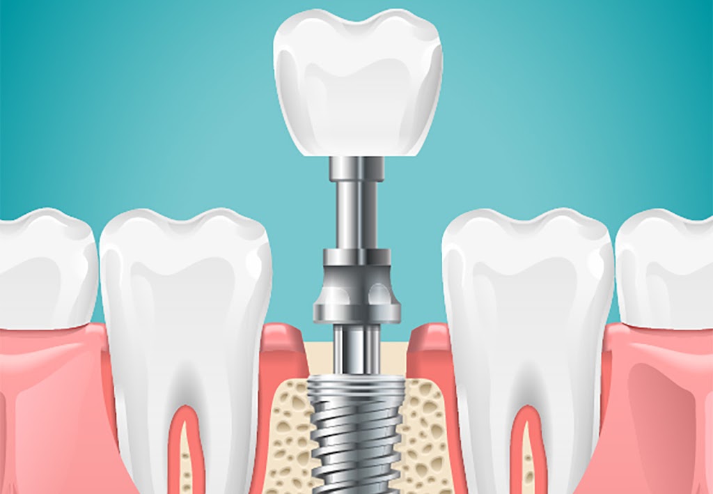 Affordable Dental Implants Middlesex County | 20 Ashley Rd, Edison, NJ 08817 | Phone: (973) 737-8473