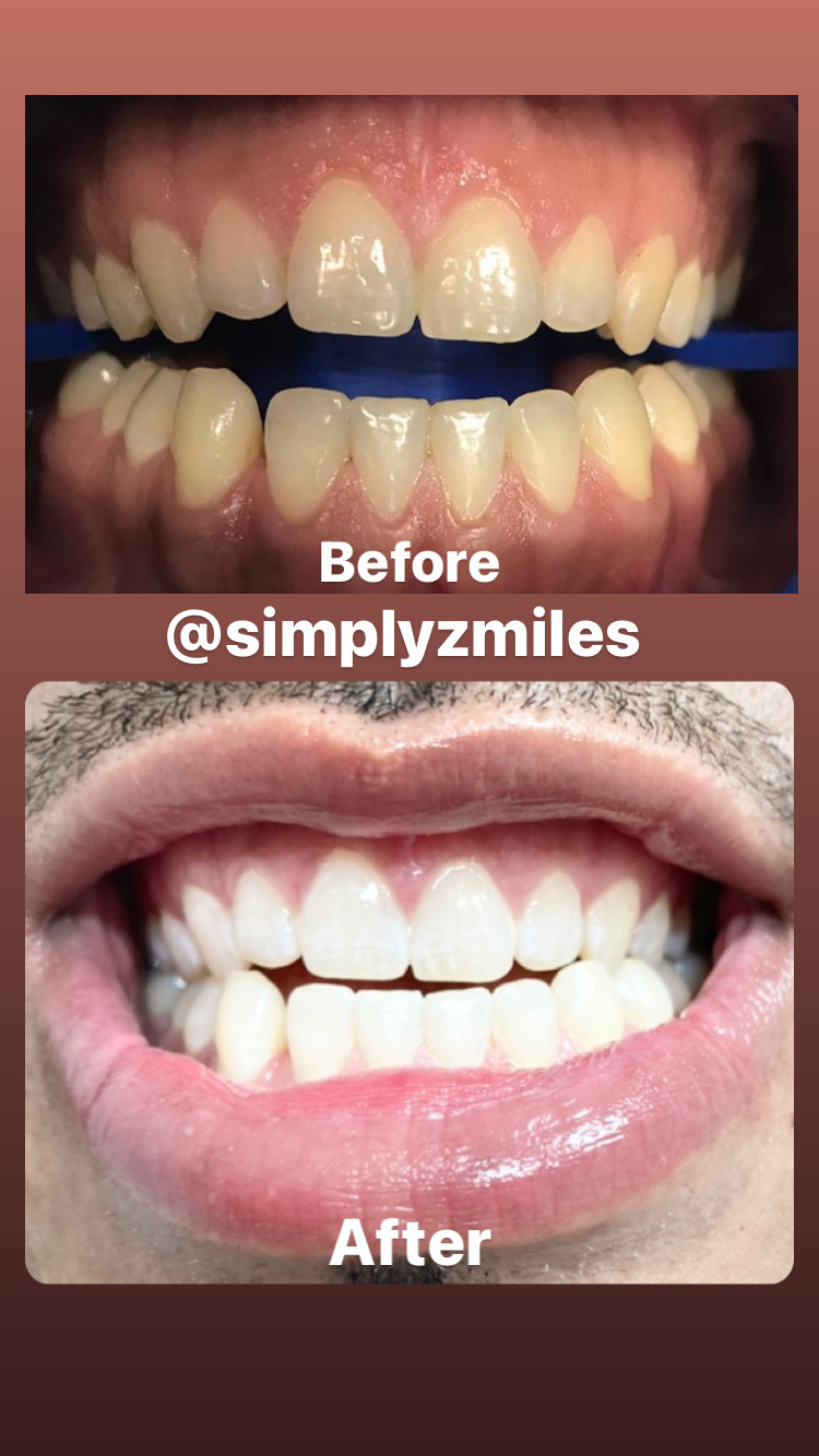 Simply Zmiles | 84-26 Jamaica Ave, Queens, NY 11421 | Phone: (718) 500-5489