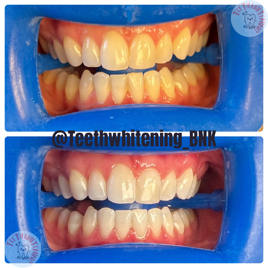 Teeth Whitening by BNK | 39 Sea Hill Rd, North Branford, CT 06471 | Phone: (203) 808-6642