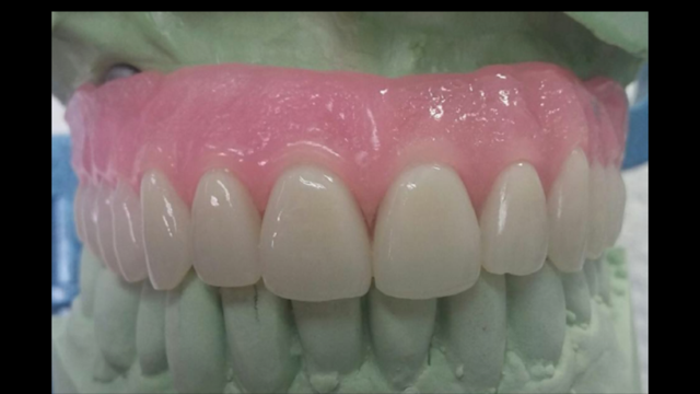 Oak Tree Denture Cosmetics Same Day Repairs!! For Dentist Only | 85 Elmora Ave, Elizabeth, NJ 07202 | Phone: (732) 499-8244