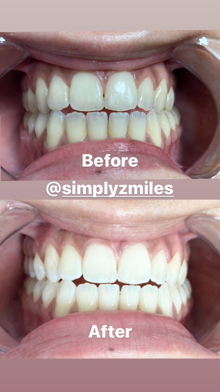 Simply Zmiles | 84-26 Jamaica Ave, Queens, NY 11421 | Phone: (718) 500-5489